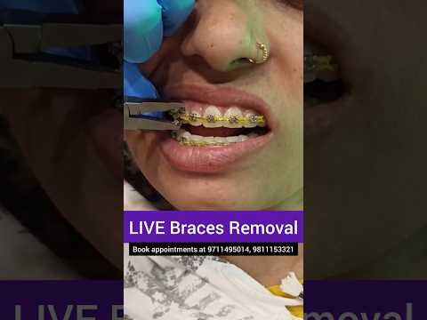 LIVE Braces Removal- Debonding; Dr. Srishti Bhatia #braces #teeth